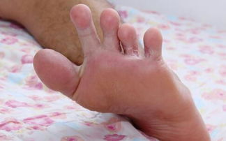 手足癣如何预防复发