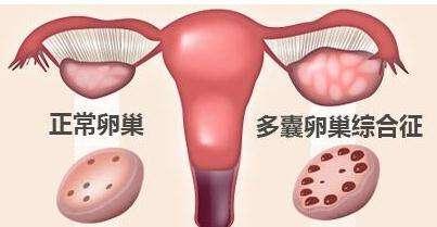多囊性卵巢综合症治疗方法