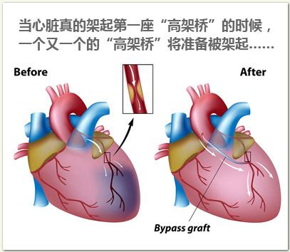 心脏搭桥手术对今后生活的影响有多大