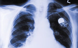 慢性阻塞性肺疾病最重要的发病因素是