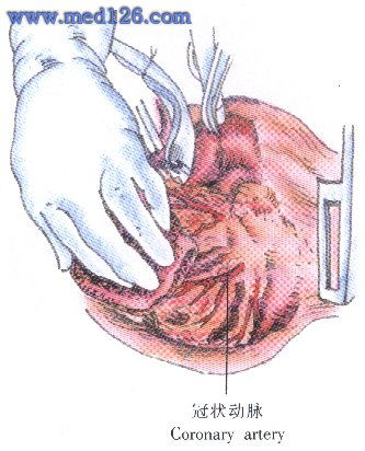 冠状动脉旁路手术