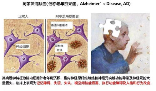阿尔茨海默症的七个阶段