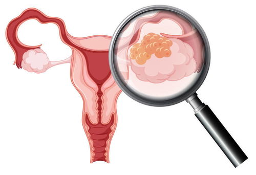 妇科肿瘤的筛查建议