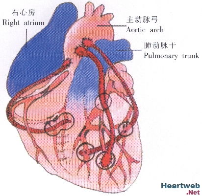 心脏搭桥手术的生活质量影响