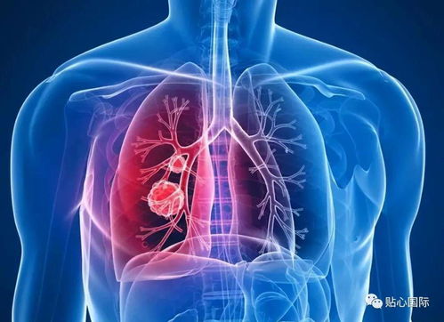 肺癌的早期筛查