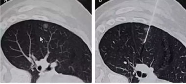 肺癌的早期筛查
