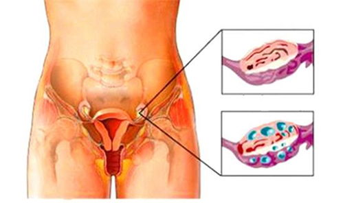 多囊卵巢综合症的治疗新进展