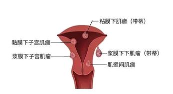 子宫肌瘤的影响