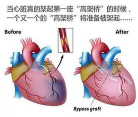 心脏搭桥手术是一种治疗心脏疾病的常见手术，它通过将身体其他部位的血管移植到冠状动脉上，以改善心脏供血情况，缓解心绞痛等症状，并提高患者的生活质量