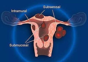 植物雌激素对子宫肌瘤的影响