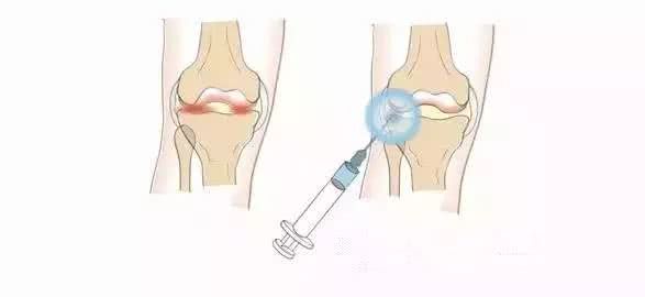 膝关节退行性变的护理目标