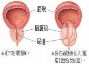 前列腺增生处理原则及护理要点