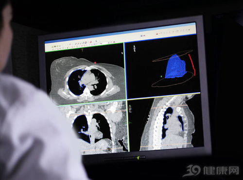 肺癌的筛查和早期诊断