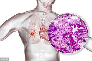 肺癌早期查血有什么变化