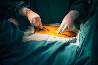 腹腔镜手术是怎么做