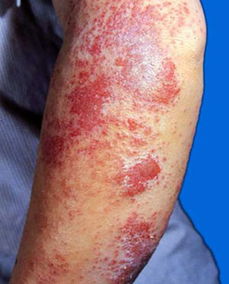 湿疹患者的护理常规