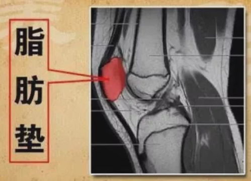 膝关节退行性改变的护理