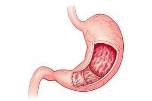 慢性胃炎最常见症状
