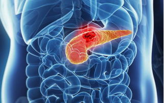 胰腺癌的早期症状能活长时间