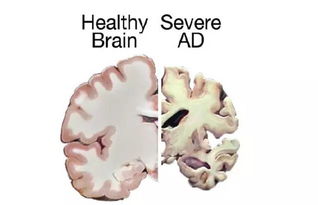 阿尔兹海默症的前兆是怎样的