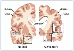 阿尔兹海默症晚期患者能活几年
