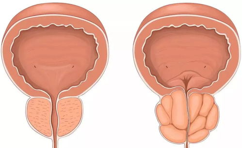 前列腺增生怎么保养