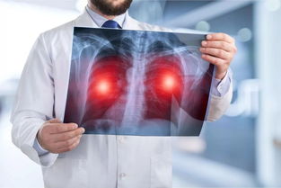 肺癌的早期筛查方法