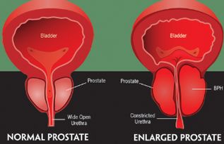 前列腺增生生活指导