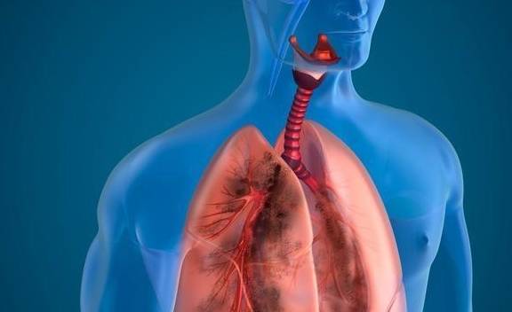 肺癌早期筛选抽血看什么