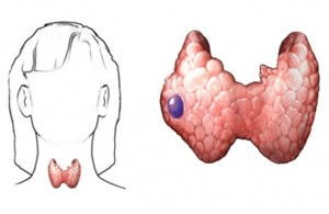 甲状腺结节风险评估3类，低度可疑恶性肿瘤