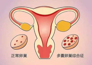 多囊卵巢综合征治疗方案选择