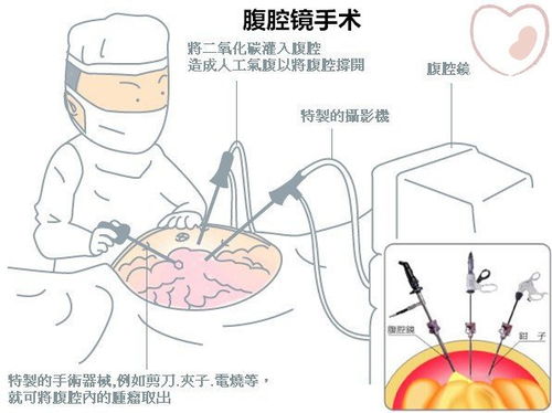 腹腔镜手术应用范围
