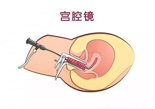 宫腔镜手术全过程