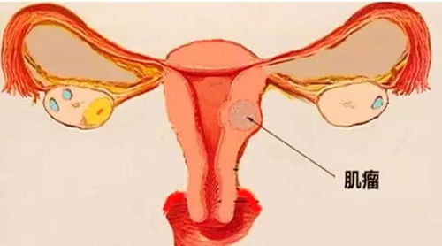 腹腔镜手术后十大禁忌之宫子宫肌瘤子宫全题