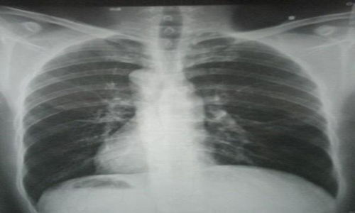 肺癌的早期检查与诊断